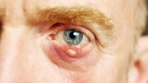 Cysta w oku – jak można ją usunąć?