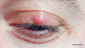 Gradówka na oku – przyczyny, objawy i skuteczne metody leczenia