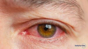Zapalenie spojówek – objawy, przyczyny i skuteczne metody leczenia