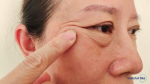 Opadnięte powieki – przyczyny, objawy i sposoby leczenia ptozy
