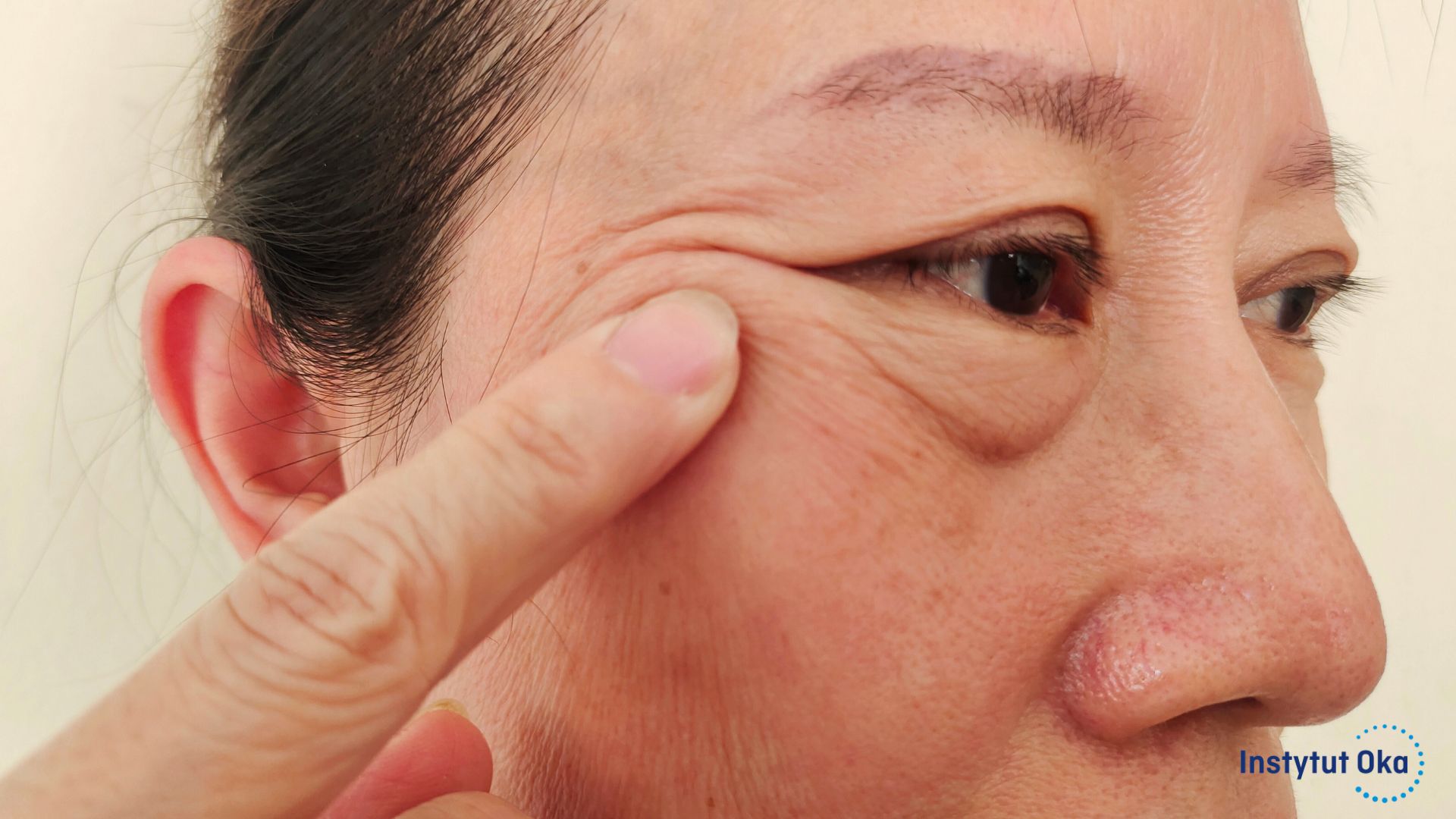 Opadnięte powieki – przyczyny, objawy i sposoby leczenia ptozy